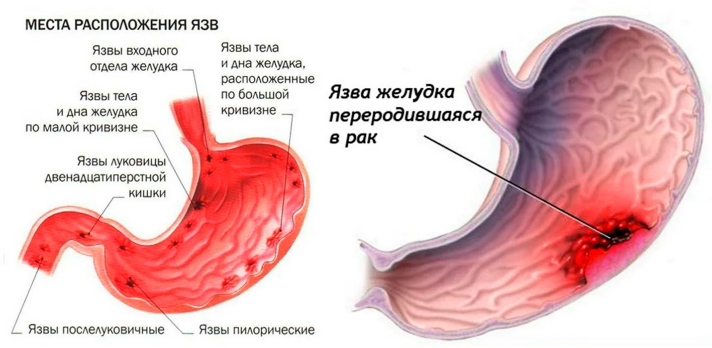 Язвенной болезни желудка язвенная болезнь желудка