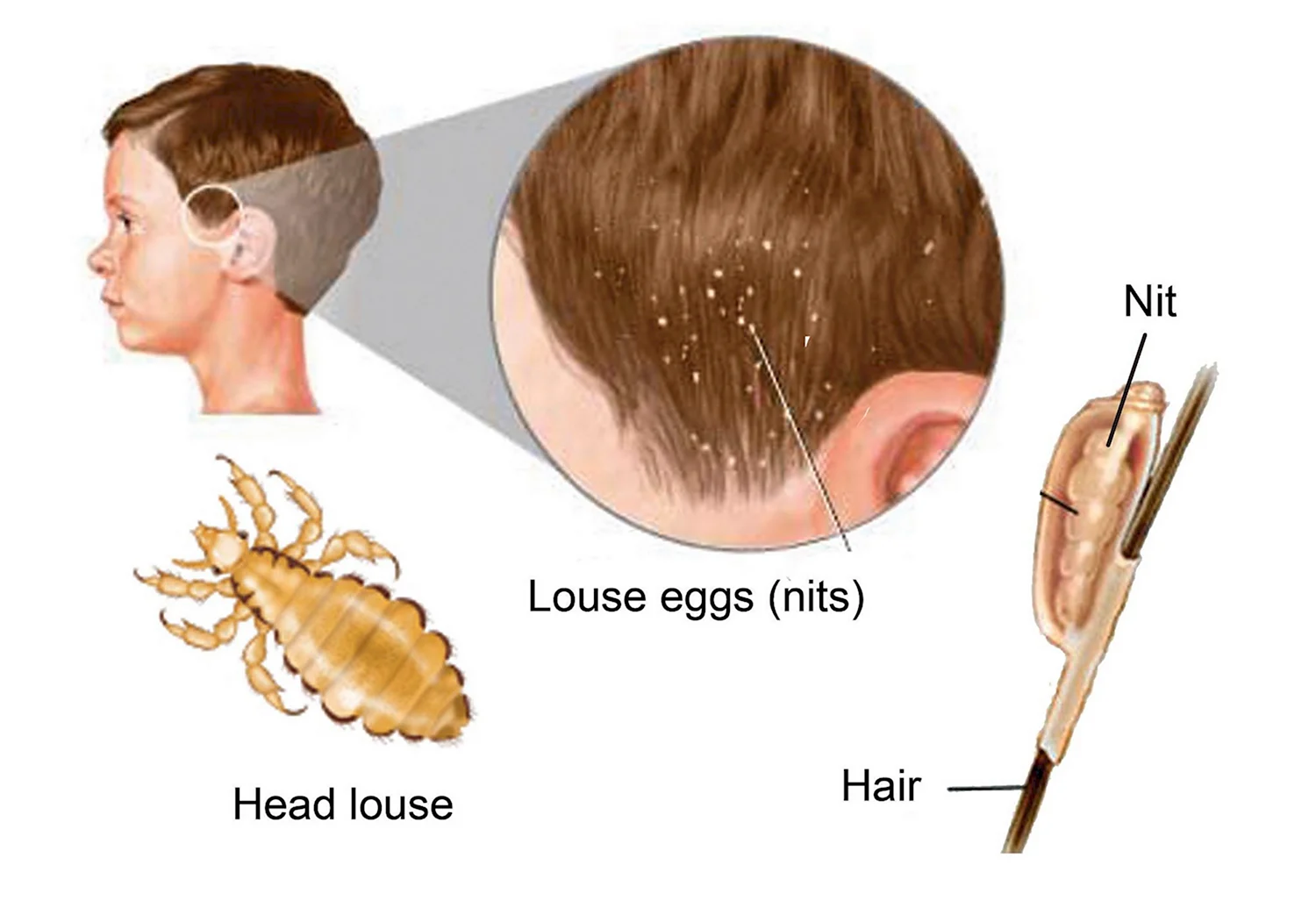 Педикулез волосистой части головы