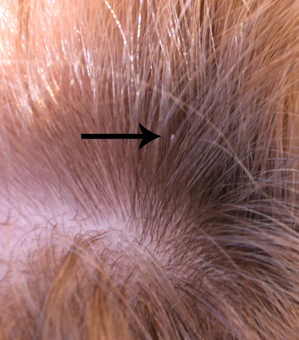 Педикулез волосистой части головы