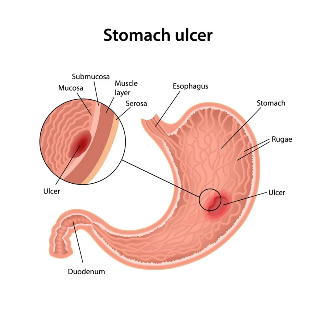 Stomach Ulcer вектор